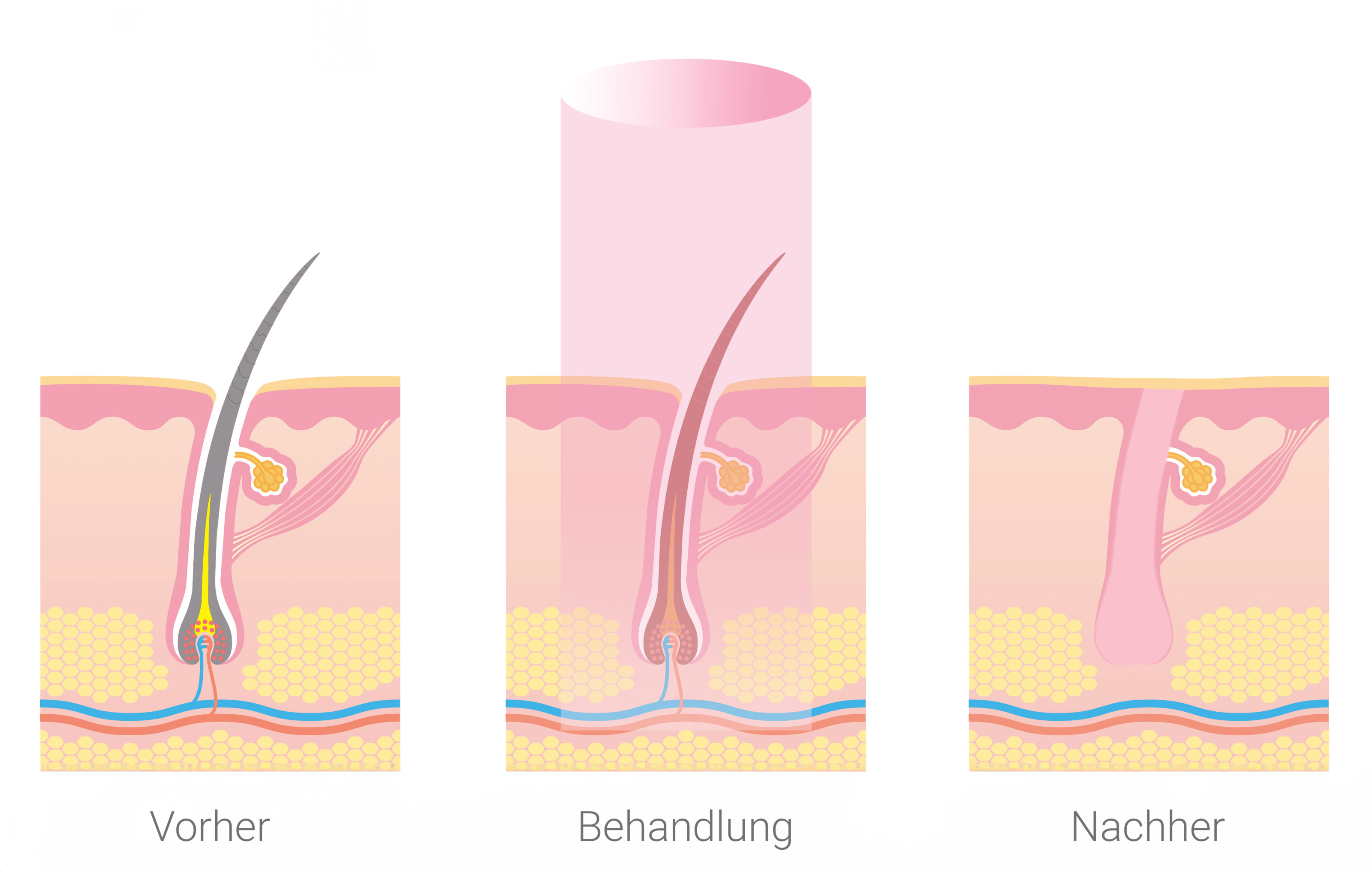 Schematische Darstellung Laserhaarentfernung zur dauerhaften Haarentfernung